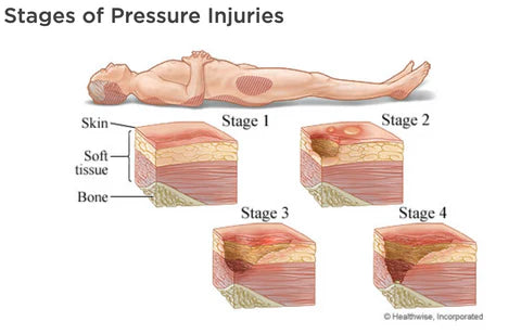 How Air Mattresses Can Help Heal Bed Sores